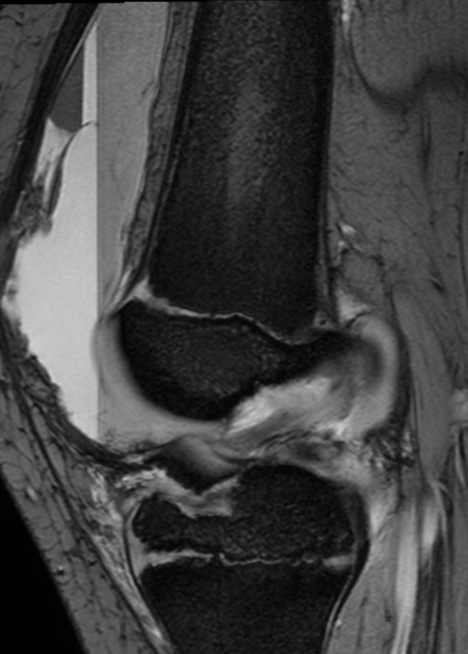 
ACL Avulsion. Click for DICOM
