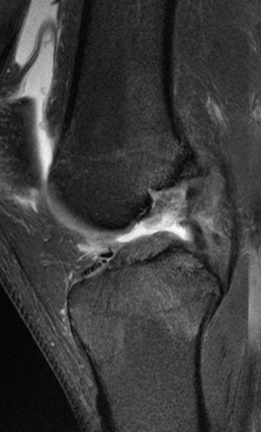 
ACL tear with longitudinal meniscal tears and injury to PLC
