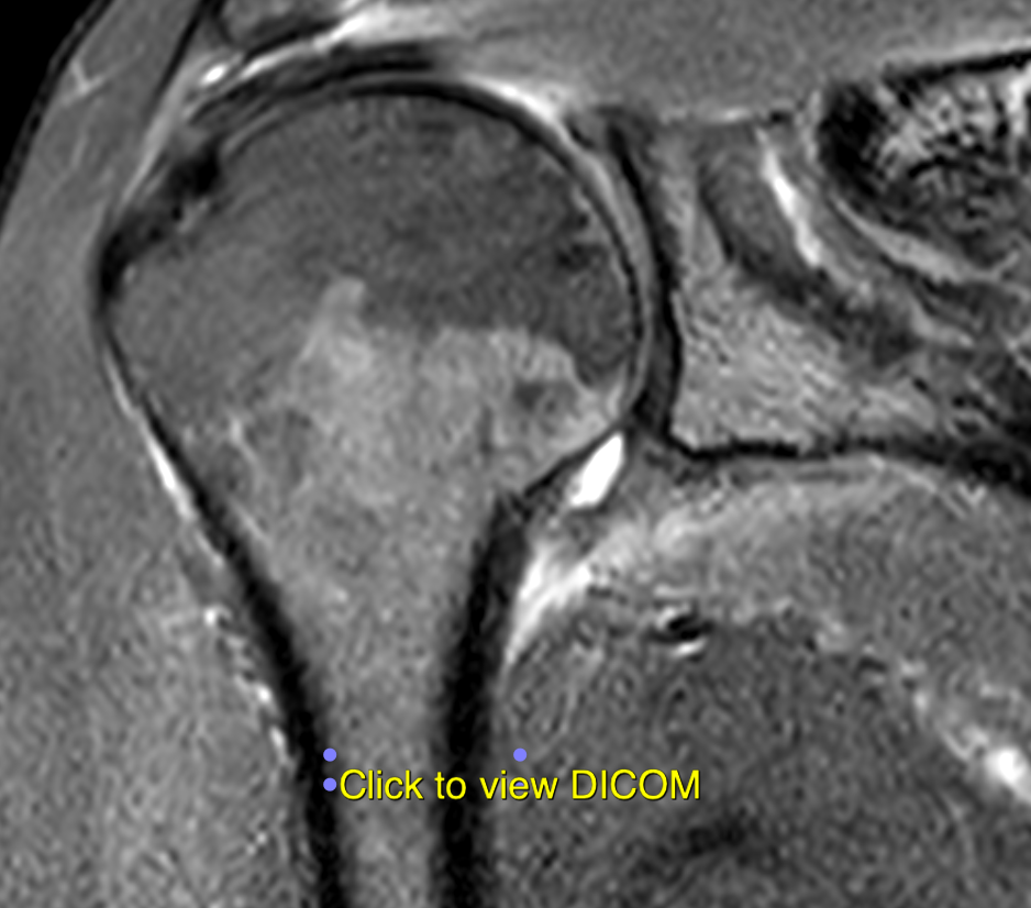 Adhesive capsulitis