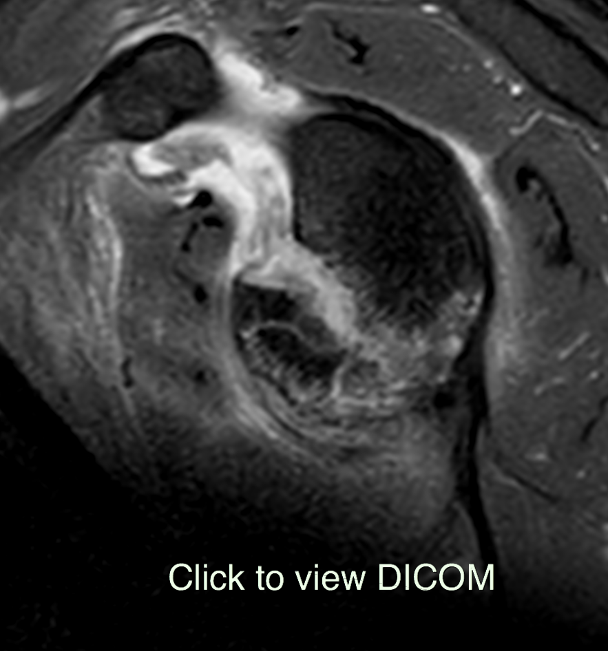 Bony Bankart lesion