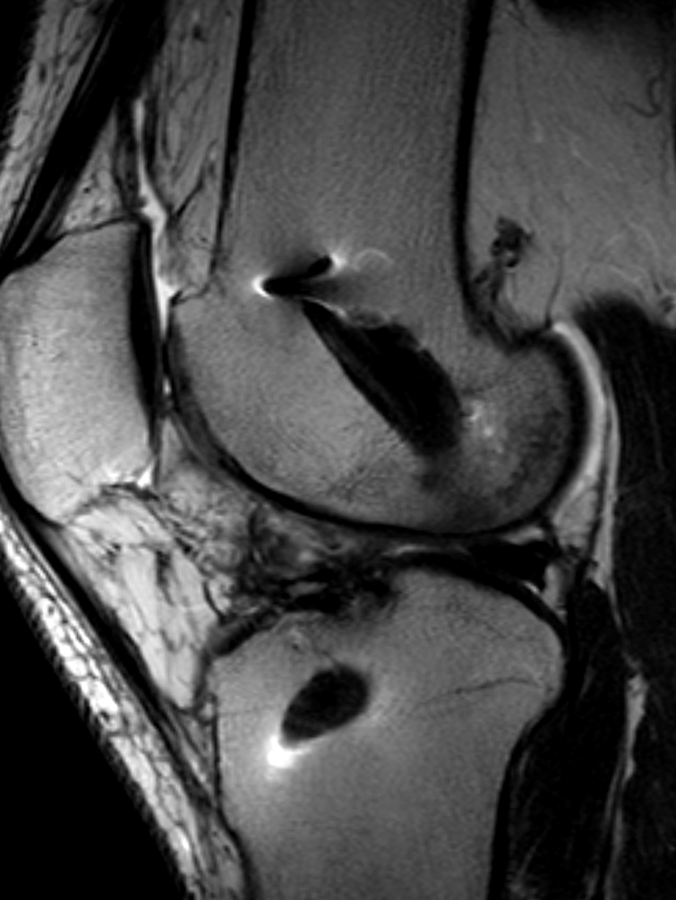 
CYCLOPS LESION FOLLOWING ACLR. Click for DICOM 

