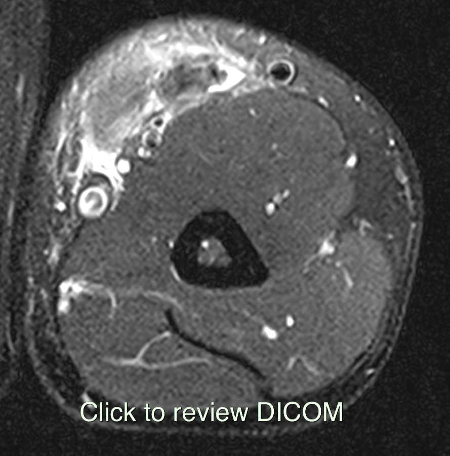 Tear distal biceps. Click for DICOM