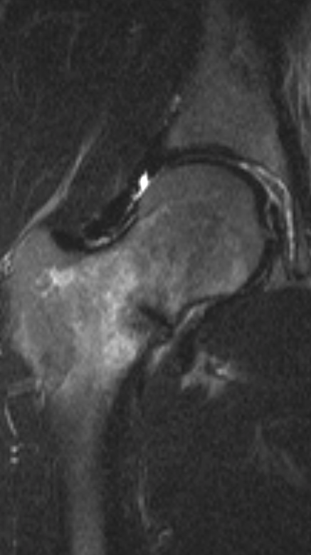 
Compression side femoral neck stress fracture. Click for DICOM


