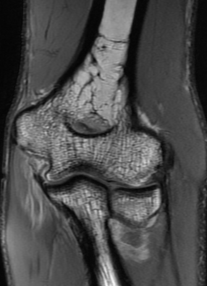 
Flexor pronator injury  Click for DICOM
