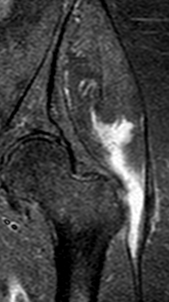 
Gluteus medius tear. Click for DICOM
