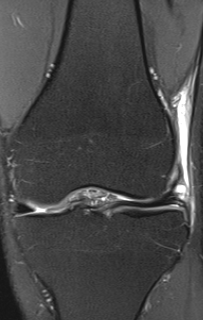 
ITB friction syndrome. Click for DICOM
