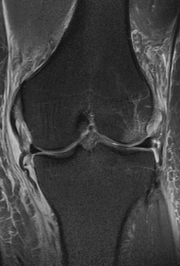 
Grade 3 MCL tear. Click for DICOM 
