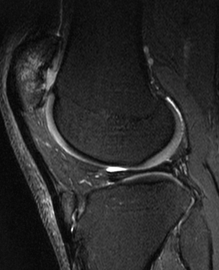 
Osgood Schlatter and discoid meniscus. Click for DICOM
