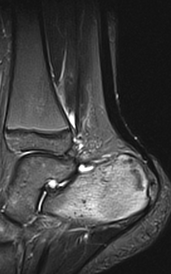 
Os Calcis stress fracture. Click for DICOM
