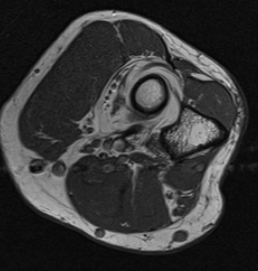 Supinator atrophy due to PIN compression. Click for DICOM