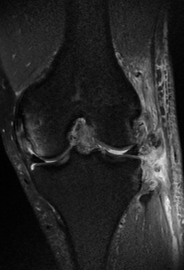 
Severe injury to posterolateral corner. Click for DICOM
