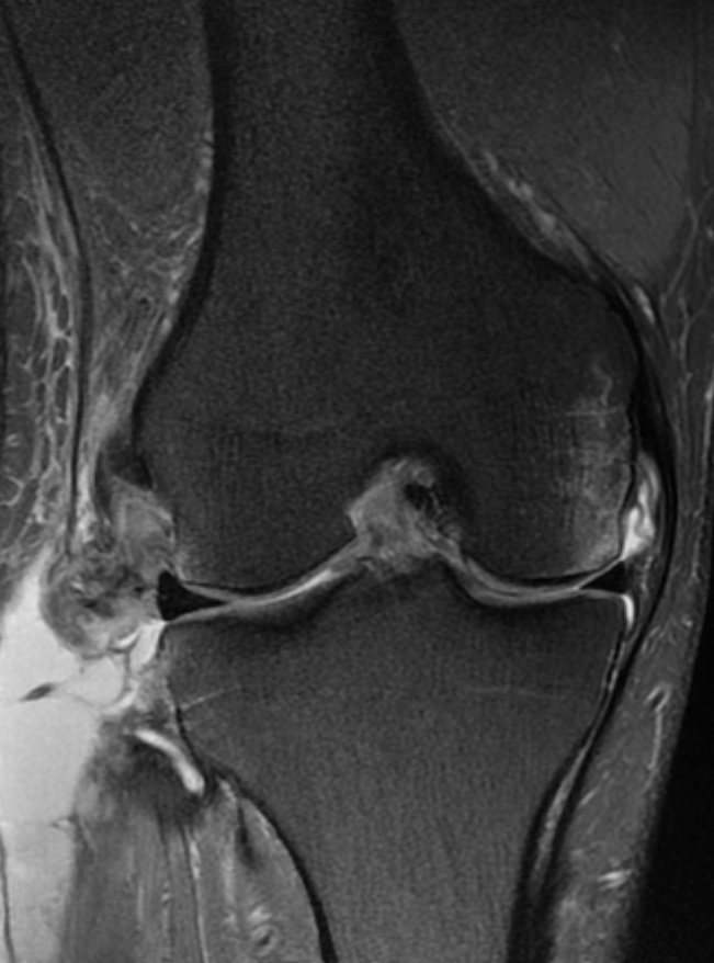 
Severe PLC injury.. Click for DICOM
