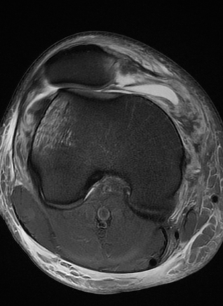 
GShallow femoral groove. Reduced dislocation. . Click for DICOM
