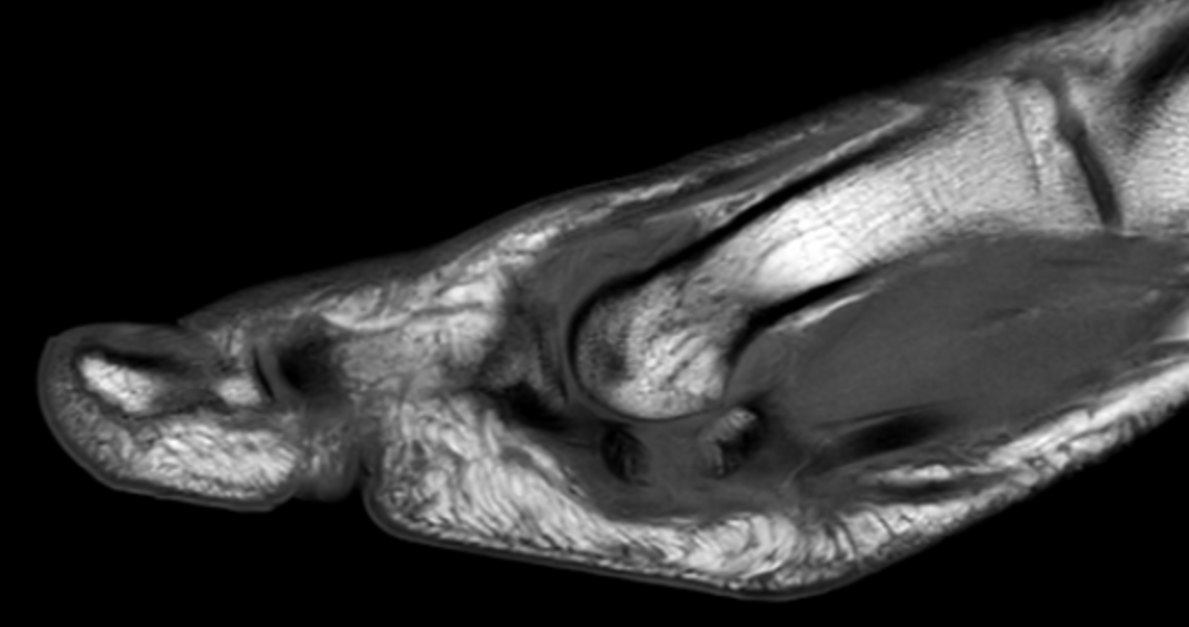 
Plantar plate injury. Sesamoid fracture. Click for DICOM
