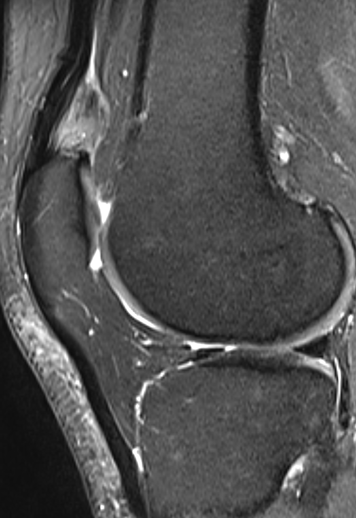 
Suprapatellar fat pad syndrome. Click for DICOM
