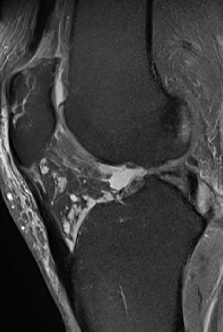 
Synovial_Haemangioma. Click for DICOM
