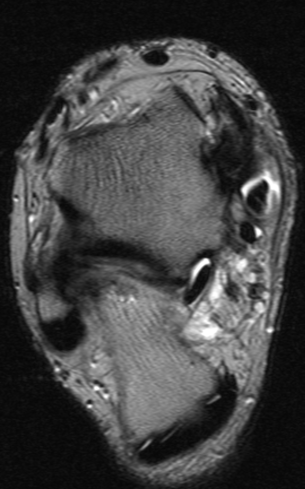 
Tibialis posterior tenosynovitis. Click for DICOM


