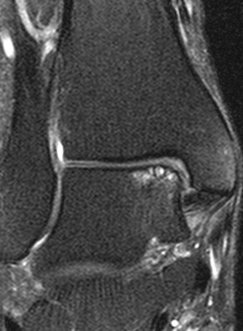 
Talar dome osteohondral lesion. Click for DICOM
