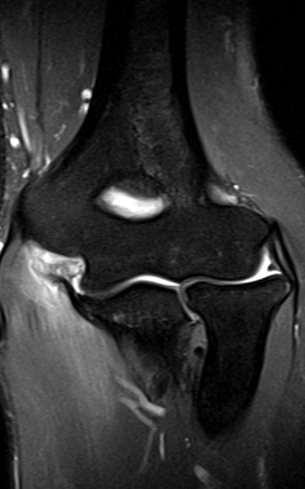 
UCL tear.  Click for DICOM. 

