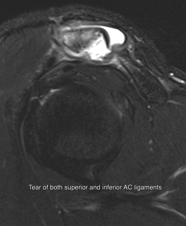 AC Joint case 1