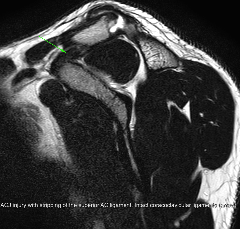 AC Joint case 3