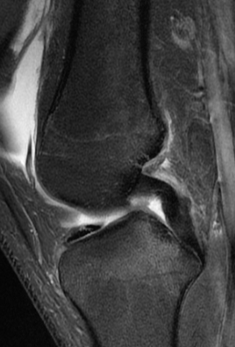 
ACL low grage PLC. Both meniscii torn. Click for DICOM
