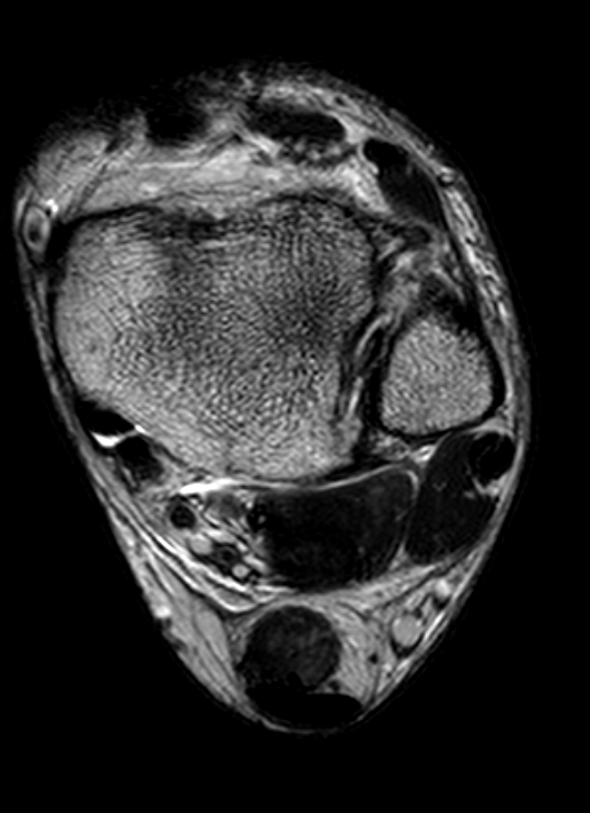 
Lat ligament and syndesmosis injuries. Click for DICOM
