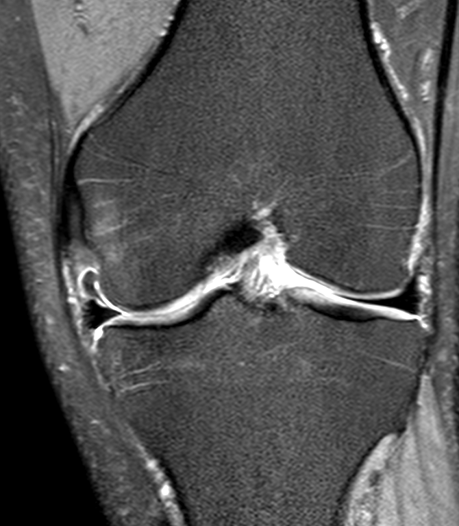 
Medial flap tear. Click for DICOM
