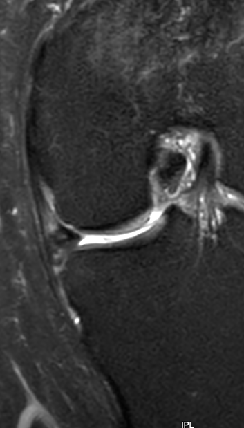 
Medial flap tear
. Click for DICOM

