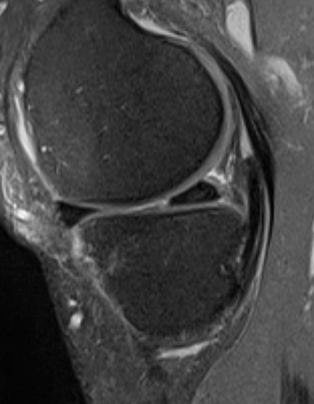 
Parrot beak type radial tear. Click for DICOM
