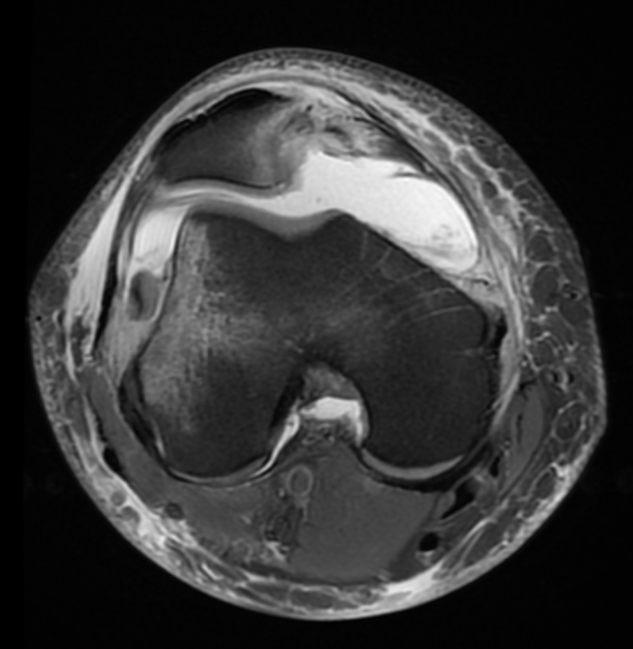 
Patellar dislocation and cartilage shear injury. Click for DICOM
