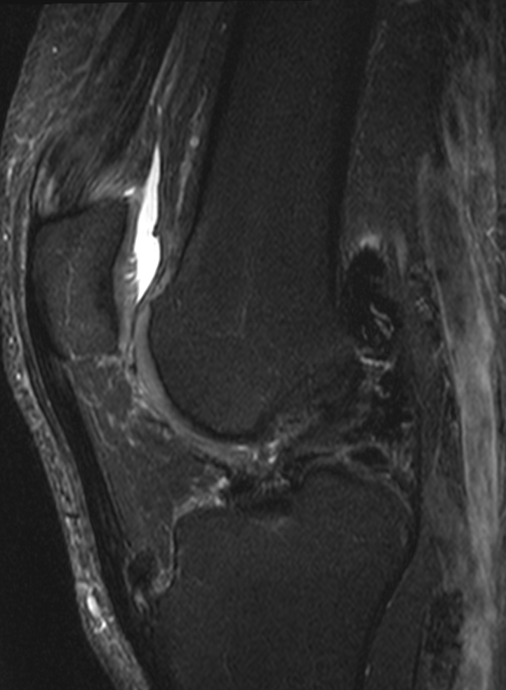 
PVNS of the knee.. Click for DICOM

