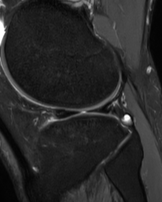 
Radial tear. Click for DICOM
