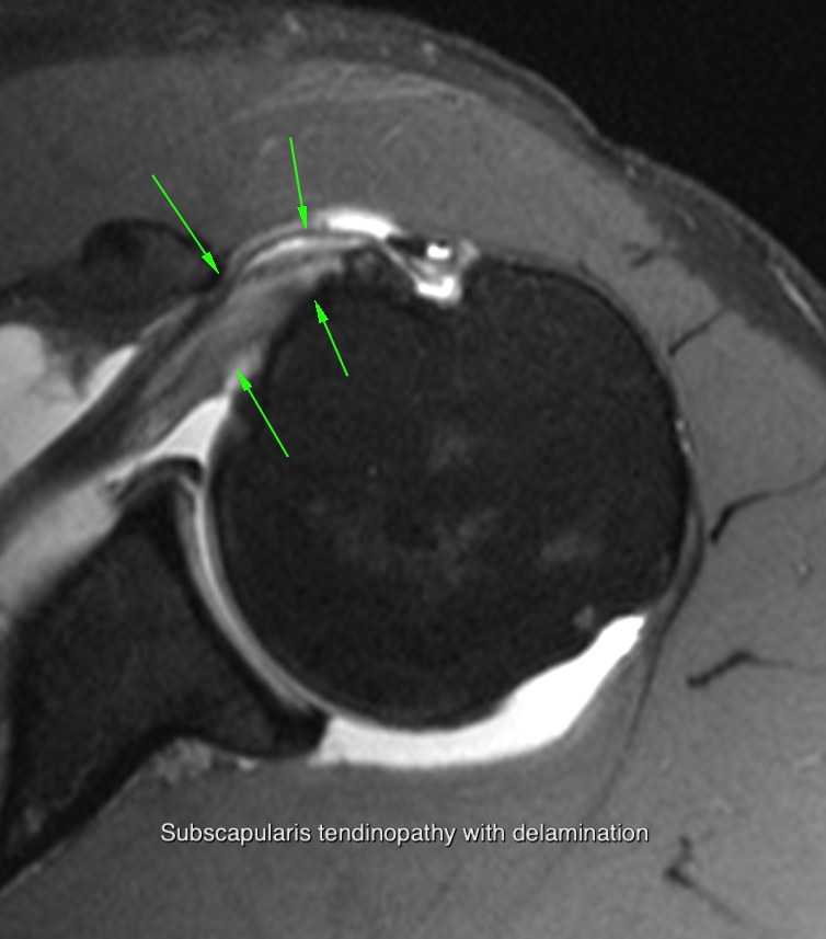 Subscapularis case 1