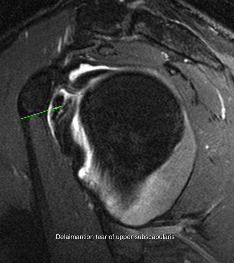 Subscapularis case 2