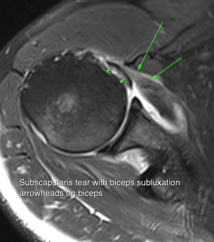 Subscapularis case 3