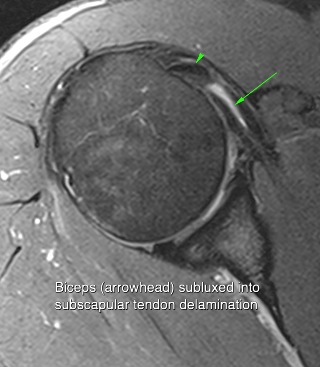 Subscapularis case 4
