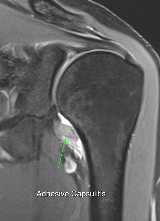 Frozen shoulder case 2