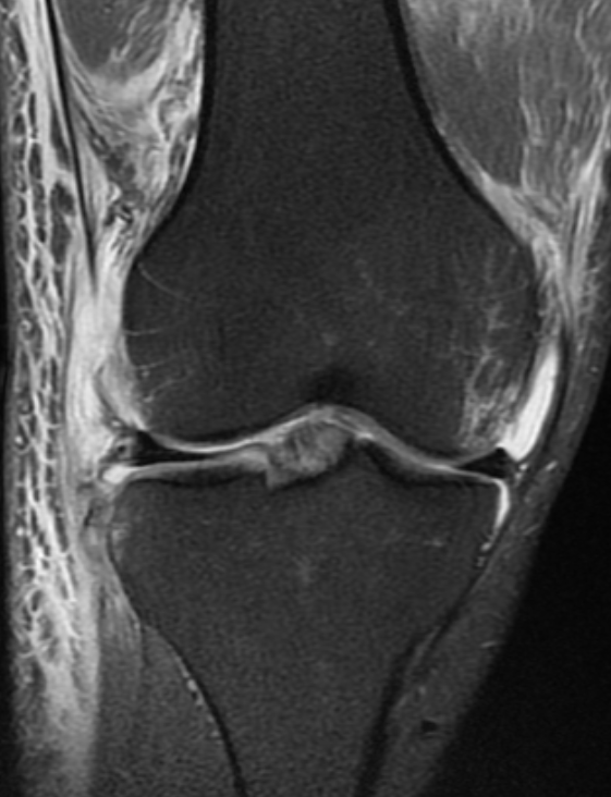 
FCL and Segond injury of the knee. Click for DICOM

