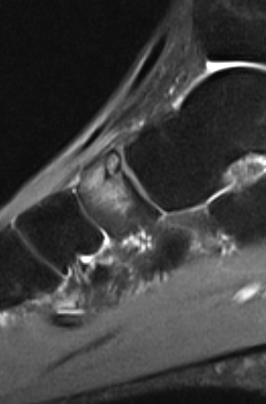 
Navicular stress and posterior impingement. Click for DICOM
