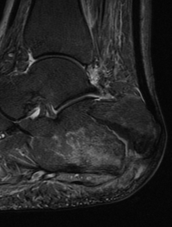
 Insufficiency fracture of the calcaneum. Click for DICOM
