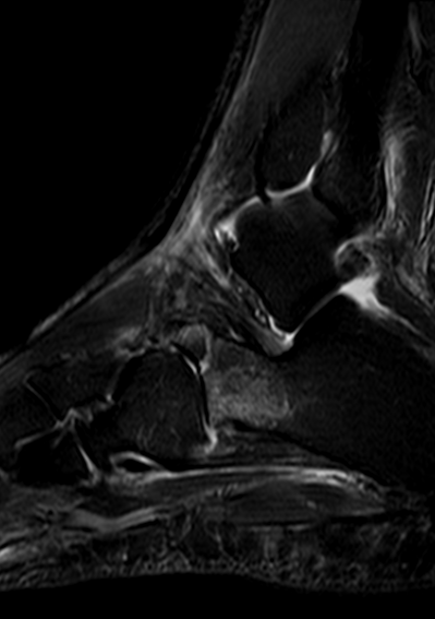 
Anterior process fracture. Click for DICOM
